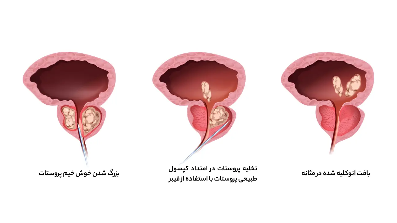 جراحی بزرگی خوش خیم پروستات با لیزر هولمیوم (روش HoLEP)